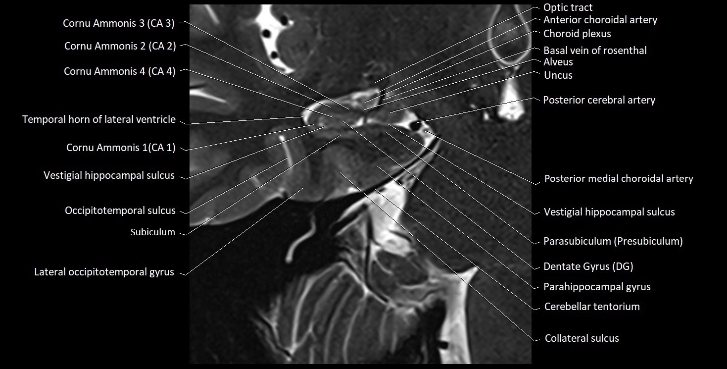 Hippocampus anatomy mri coronal cross section 3T MRI image 7.webp